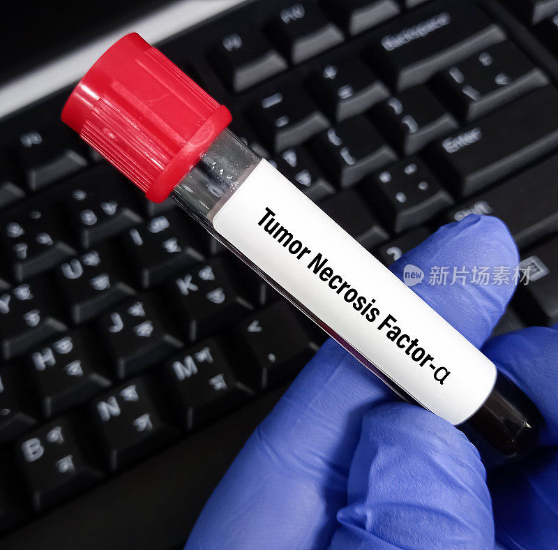 Blood sample for Tumor necrosis factor α(TNF-α) test, an inflammatory cytokine produced by macrophages or monocytes during acute inflammation.